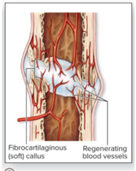 <p>Formation of Fibrocartilage to stabilize fracture</p>