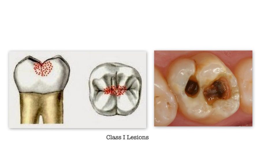 <ul><li><p>Pits and fissures of <span style="color: yellow;"><strong>occlusal surfaces of posterior</strong></span></p><p><span style="color: yellow;"><strong>teeth (premolars and molars)</strong></span></p></li><li><p>Pits in the occlusal 2/3 of facial and</p><p>lingual surfaces of molars</p></li><li><p>Smooth proximal surfaces of posterior teeth</p><p>(premolars and molars)</p></li></ul><p></p>