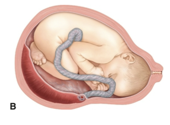 <p>Occurs when the umbilical cord inserts at the placental margin</p>