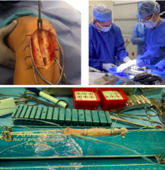 <p>- Refer to orthopaedics</p><p>- Non operative if > 40, low demand</p><p>Operative </p><p>- Reconstruction: using grafts (allograft vs autograft)</p><p>- Repair: emerging approach</p>