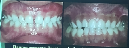 <ul><li><p><span style="background-color: transparent;">Tipo I, dentición espaciada, correspondiente a arcos amplios.</span></p></li><li><p><span style="background-color: transparent;">Tipo II, cerrada, arcos angostos.</span></p></li></ul><p></p>