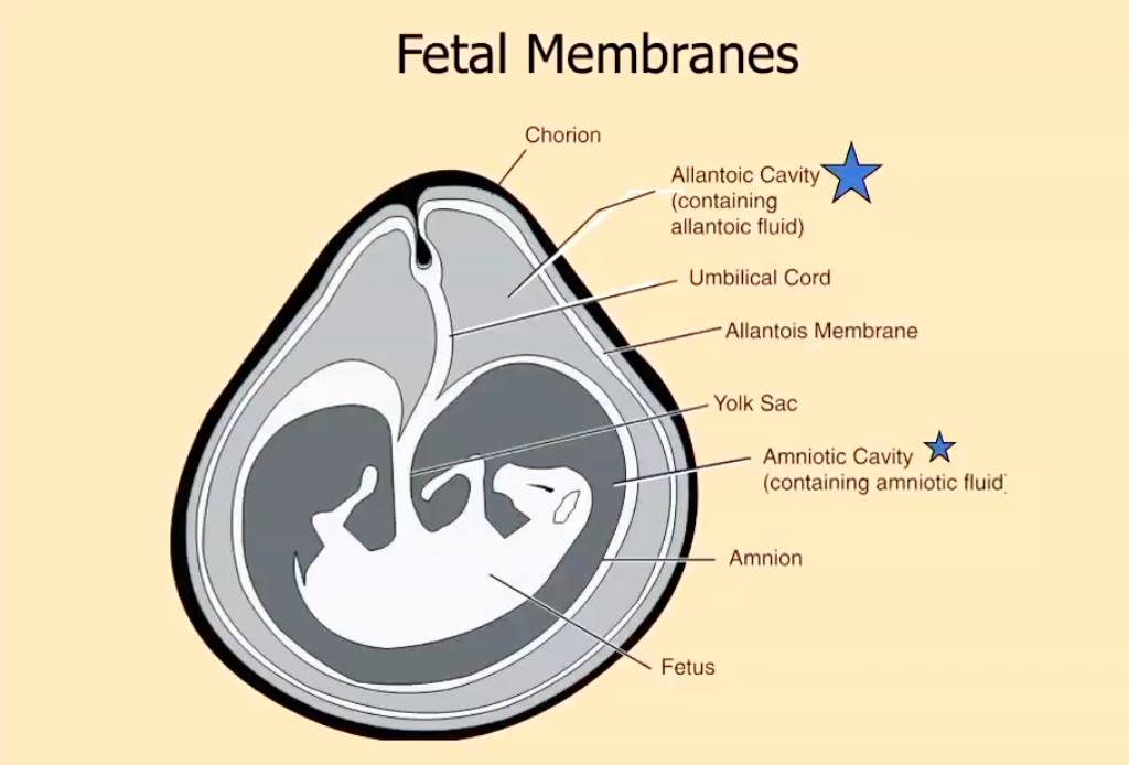 <p>• Increased production/ accumulation fluid</p><p><strong>• Hydrallantois </strong>- allantoic sac (outside)</p><p>• Associated with placental disease</p><p>• 3rd trimester, acute (weeks)</p><p>• CS - Distended abd, +/- systemic signs, down, prepubic tendon rupture</p><p>• Rectal - can't feel placentomes, uterus everywhere (can use ultrasound to confirm)</p><p>• Tx - elective c section or induce (see CP 1.5)</p><ul><li><p>Steroids but...causes immunosuppression</p></li><li><p>PGF 2 alpha but...placenta can maintain prostaglandin</p></li><li><p>Px- poor, cull as can recur</p></li></ul><p>Hydramnios - amnionic sac</p><p>• Foetus can't regulate fluid (often dead)</p><p>• Chronic</p><p>• Can feel placentomes</p><p>• No reason to cull cow</p>