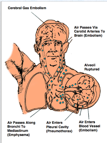 <p><span>when breathing compressed gas at depth and failing to exhale, or when air is trapped, causing the expanding gas to rupture lung tissue = alveoli ruptured, air passes through blood vessels and pleural cavities along bronchi to mediastinum and through carotid arteries to brain = death</span></p>