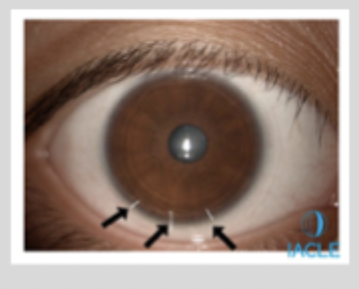 <ul><li><p>3 lines around 6 O’clock </p></li></ul><p></p><ul><li><p>30 degree separation (15 each)</p></li></ul><p></p><ul><li><p>Purevision Toric, Purevision 2 toric </p></li></ul><p></p><ul><li><p>Optima Toric </p></li></ul><p></p><ul><li><p>Soft CL toric </p></li></ul><p></p>