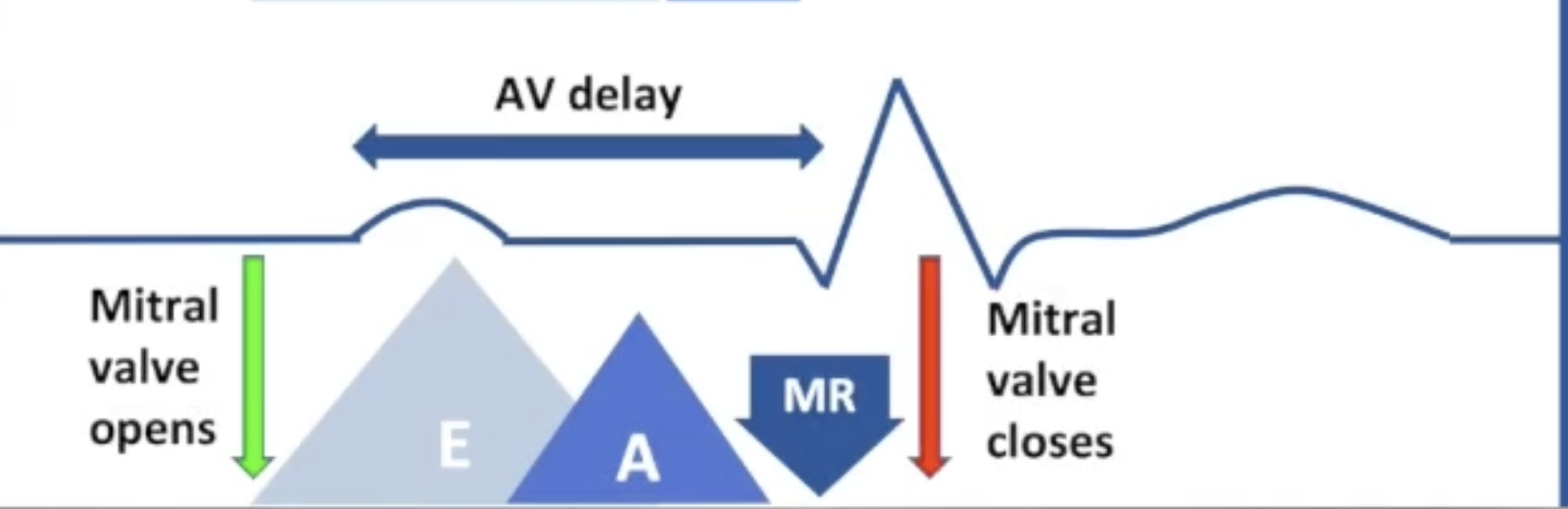 <ul><li><p>AV delay too long:</p><ul><li><p>Ventricular contraction delayed</p></li><li><p>Ventricular relaxation delayed: late E wave</p></li><li><p>Fused E/A wave: A wave begins part way through E wave</p></li><li><p>Diastolic MR</p></li></ul></li></ul><p></p>