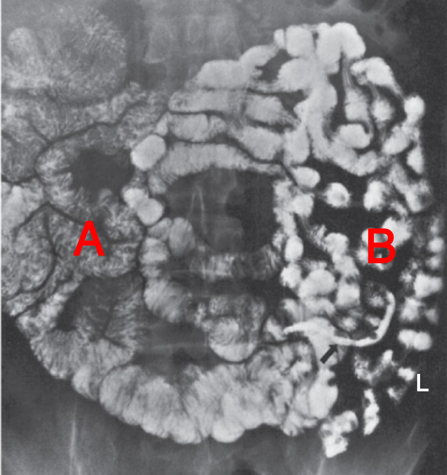<p>On barium imaging, <strong>segment A</strong> of small bowel shows a “feathery” pattern from extensive mucosal folds</p>