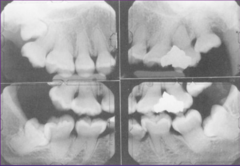 <p>-Obliteration of pulp chamber </p><p>- filled with reparative dentin</p><p>-small underdeveloped roots</p><p>-roots + fractures</p>