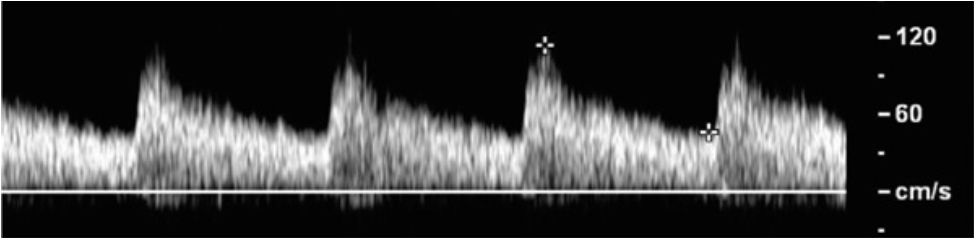 <p>The image has spectral broadening. What might be one way to eliminate the spectral broadening in this image?</p><p>(A) Open spectral gate wider</p><p class="p1">(B) Decrease the spectral gain</p><p class="p1">(C) Elevate the baseline</p><p class="p1">(D) Increase the PRF</p>