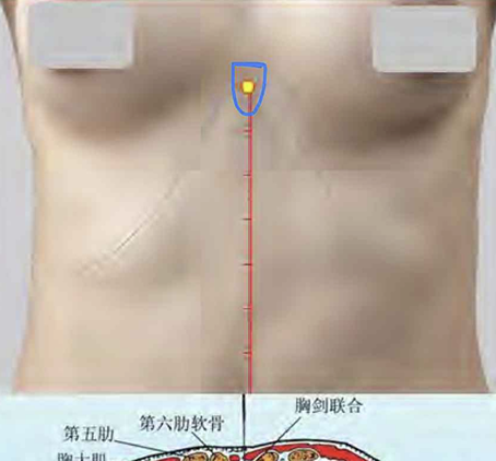 <p>앞정중선 위, 칼몸통결합의 중점</p>