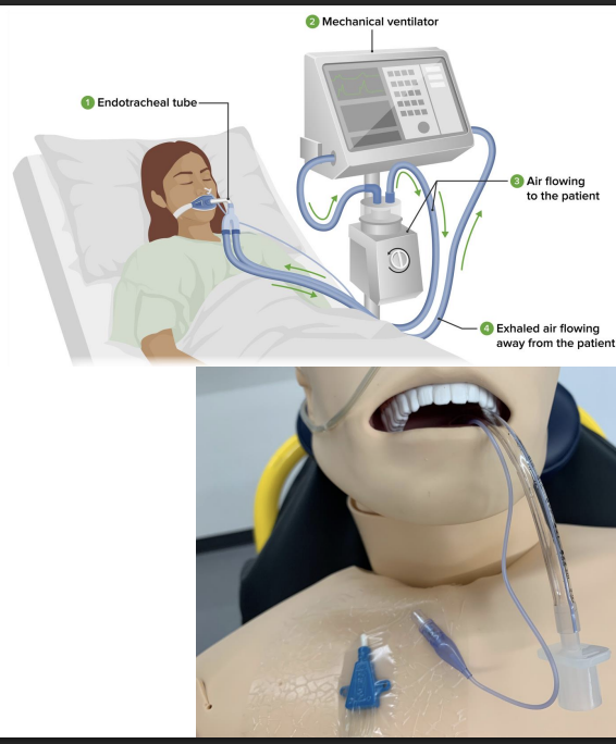 <p>Tube</p><p>Purpose: airway, mechanical ventilation (connected to mechanical ventilator)</p>