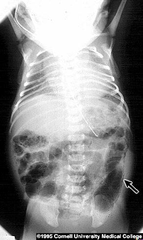 <p>A 5 day old former 33 weeker develops bloody diarrhea</p><p>- What do you see on xray?</p><p>- Treatment? </p><p>- Risk factors?</p>