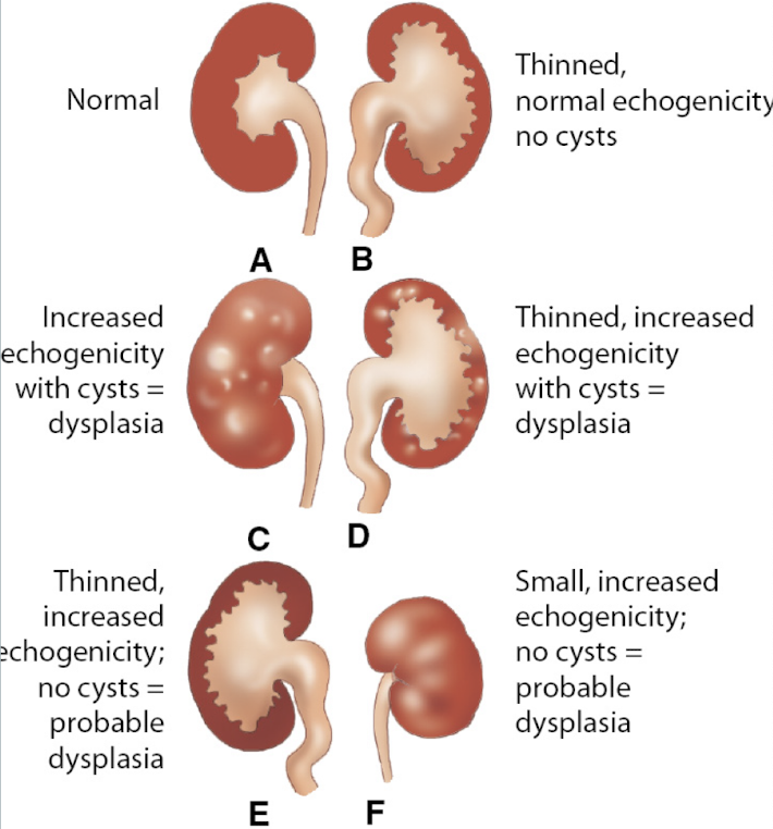 <ul><li><p>renal dysplasia occurs secondary to long standing kidney obstruction in the 1st/early 2nd trimester</p></li><li><p>leads to fibrosis and cystic replacement of renal tissue</p></li><li><p><u>if unilateral disease</u>:</p><ul><li><p>from UPJ or UVJ obstruction</p></li><li><p>variable prognosis: depends on additional anomalies</p></li></ul></li><li><p><u>if bilateral disease</u>:</p><ul><li><p>from bladder outlet obstruction</p></li><li><p>poor prognosis b/c no AFI → renal failure and pulmonary hypoplasia</p></li></ul></li></ul><p></p>