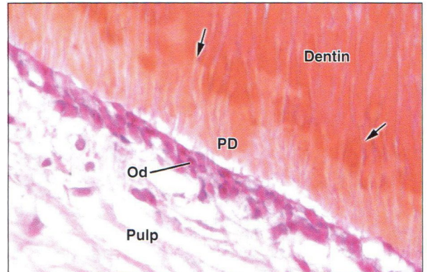 <p>Calcoshperites: </p><ul><li><p>spherical foci of hydroxyapatite</p></li><li><p>grow and coalesce</p></li></ul><p>Irregular mineralization front</p><p>fast dentin deposition rate</p><p>seen in mantel and circumpulpal dentin (1 and 2 layers)</p>