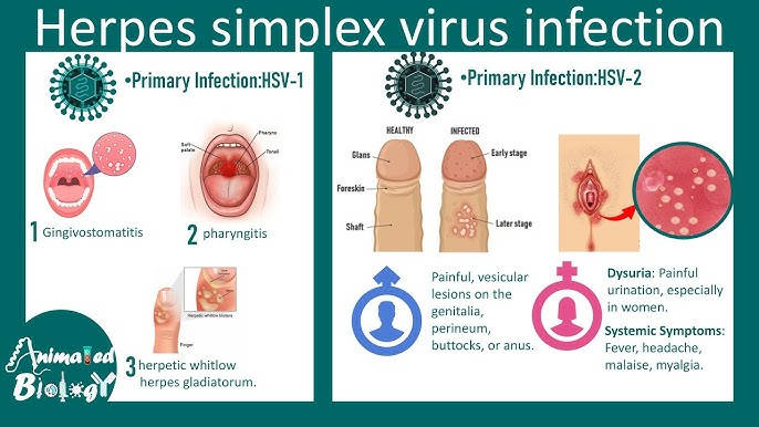 <p>This is what infection?</p>