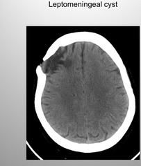 <p>Leptomeningeal Cyst- Growing fracture</p>