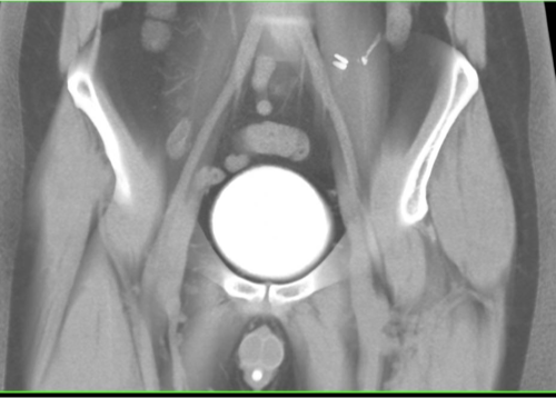 <p>What does this refer to</p><ul><li><p>Approximately 100 mL of contrast material is placed into the bladder via the urinary catheter</p></li><li><p>Plain film is taken to check for gross bladder extravasation</p></li><li><p>If negative</p><ul><li><p>Add 200-250ml contrast until bladder is filled</p></li></ul></li><li><p>Drain bladder</p></li><li><p>Post drain xray to assess for contrast behind distended bladder</p></li></ul><p></p>