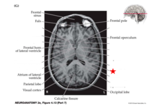 <p>A highly vascular portion of the lining of the ventricles that secretes cerebrospinal fluid.</p>