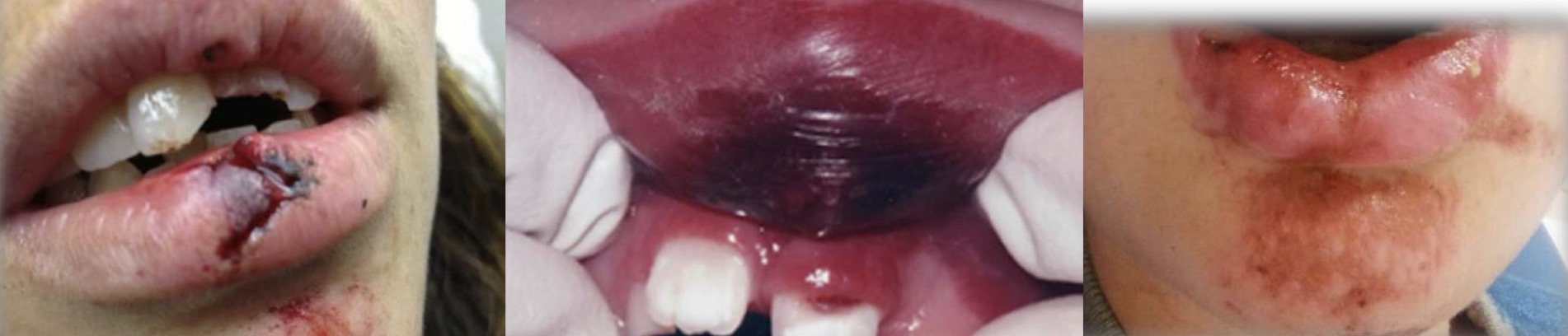 <p><strong>Laceration</strong>- cut/tear in skin by being struck by a blunt or penetrating object</p><p><strong>Contusion</strong>- Injury with submucosal haemorrhage that occurs without tearing- usually blunt object</p><p><strong>Abrasion</strong>- superficial wound caused by tearing of mucosa- bleeding and rough surface</p>