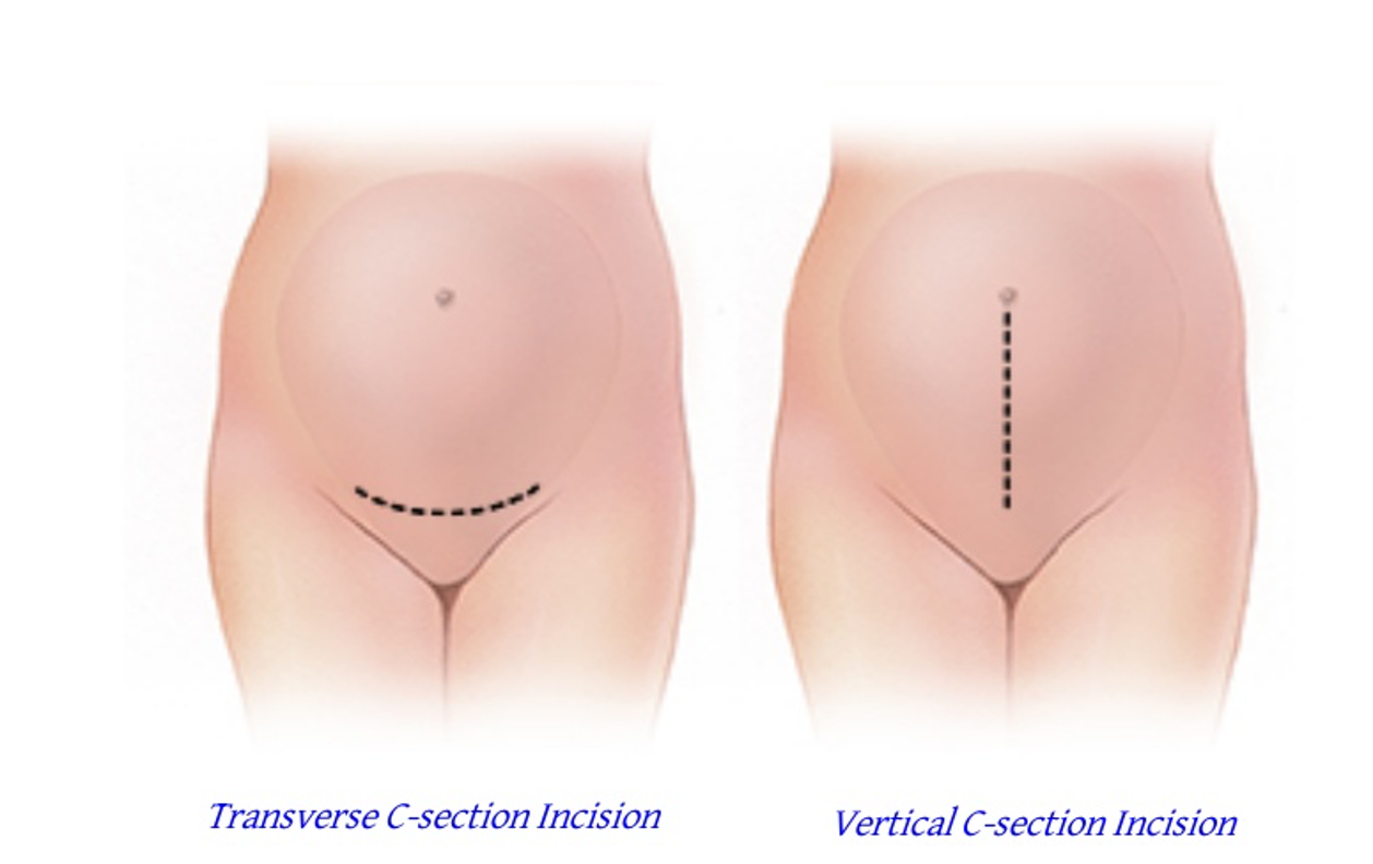 <ul><li><p><span style="font-family: "Aptos Light";"><span>Most commonly Pfannensxiel incision </span></span><span><span>→</span></span><span style="font-family: "Aptos Light";"><span> curved transverse incision 2-3 cm above </span><strong><span>pubic symphysis</span></strong><span>, through the skin and subcutaneous tissue</span></span></p></li></ul><p></p><p></p>