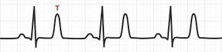 <p>Hyperkalemia Treatment - early symptoms </p>