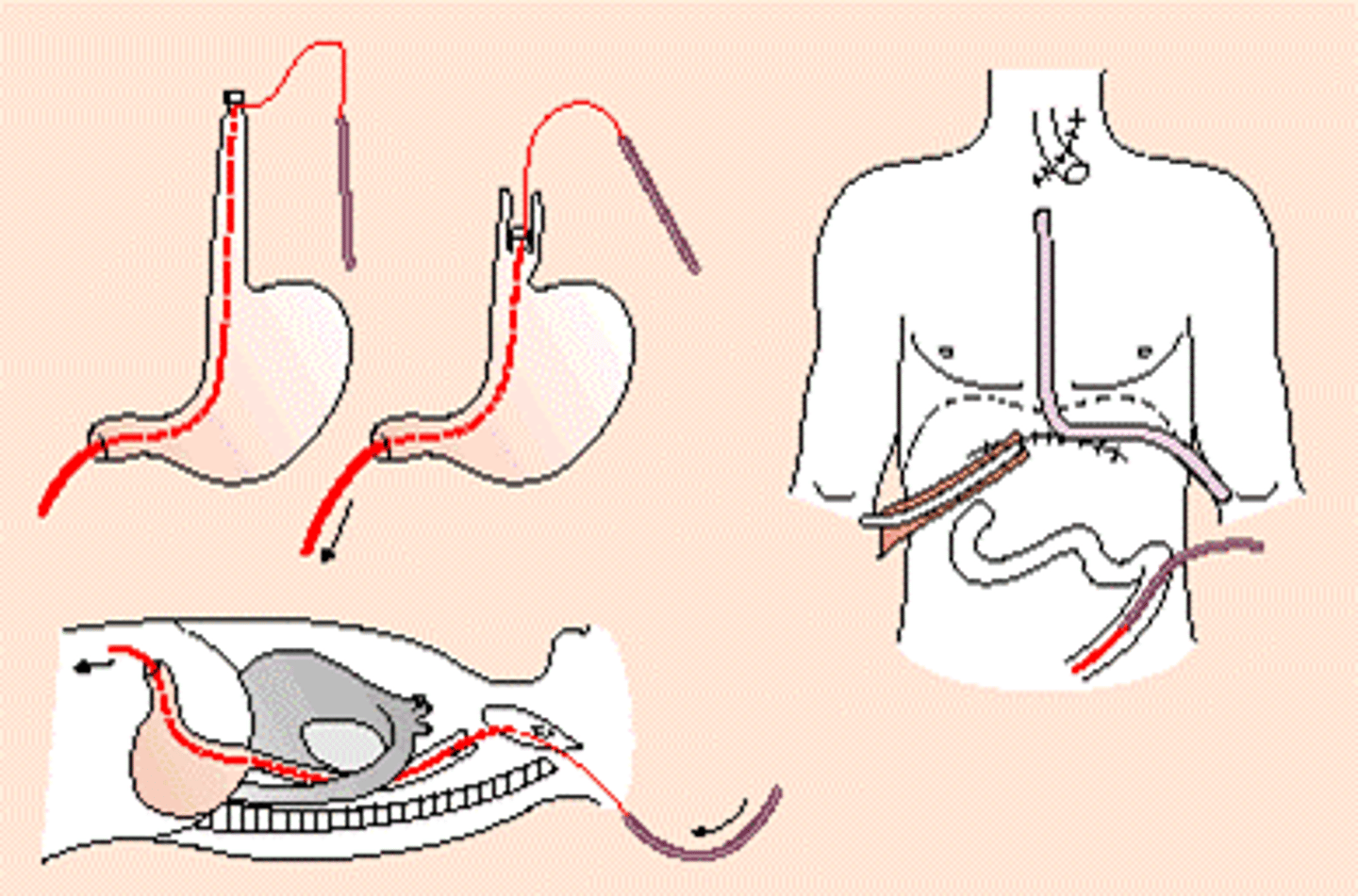 <p>esophagoscopy</p>