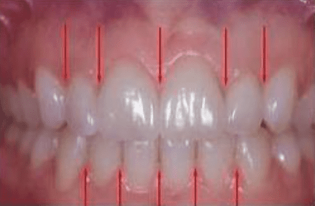 <ul><li><p>Portion of gingiva that fills interdental embrasure between two adjacent teeth apical to contact area</p></li><li><p>Consist of facial papillae and lingual papillae </p></li><li><p>interdental col - depression apical to contact area of adjacent teeth that connects facial and lingual papillae</p></li><li><p><span style="color: blue;">Function: Prevents food from packing between teeth when chewing</span></p></li></ul><p></p>