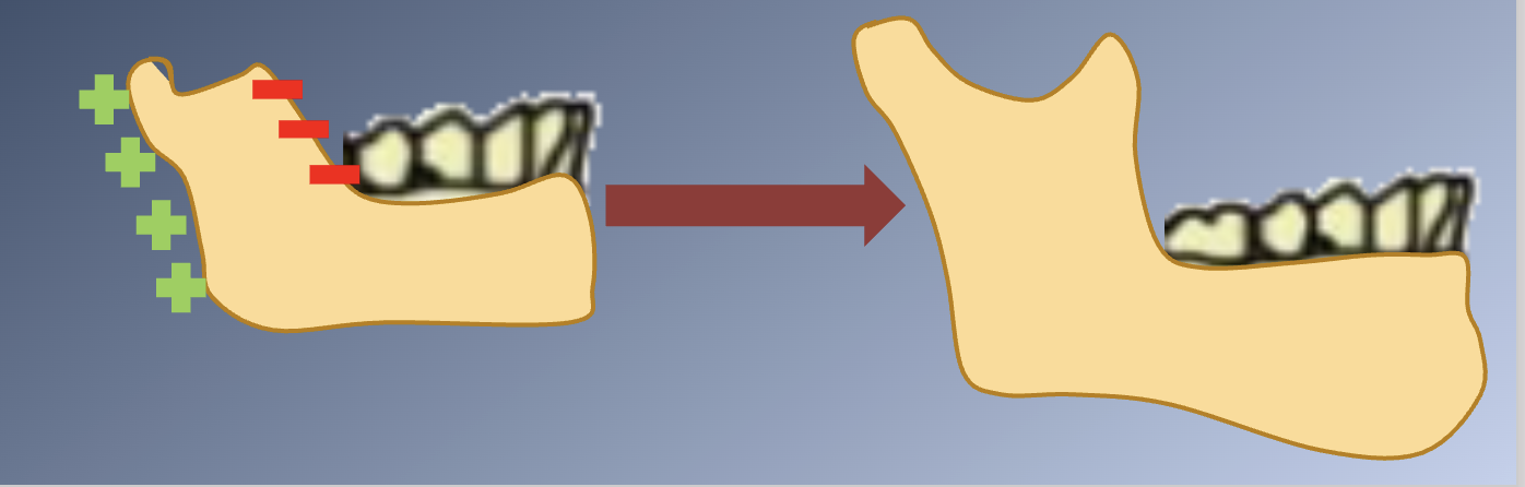 <p><span>• CHIN: inactive, translated downward and forward</span><br><span>– Growth not possible by cartilage replacement or interstitial bone growth.</span><br><span>– Remodeling</span><br><span>• BODY of the mandible:</span><br><span>– Grows by PERIOSTEAL APPOSITION of bone on its</span><br><span>POSTERIOR surface.</span><br><span>• RAMUS:</span><br><span>– ENDOCHONDRAL replacement at the condyle</span><br><span>– SURFACE REMODELING</span></p><p><span>GROWTH SITES:</span><br><span>• The mandible grows longer by apposition of new bone on the posterior surface of the ramus.</span><br><span>• Large quantities of bone are removed from the anterior surface of the ramus.</span></p>