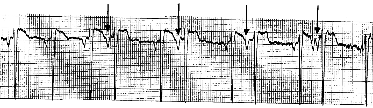 <p>What ECG is this? </p>