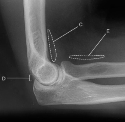 <p><strong>On this true lateral elbow projection, when is E commonly used for? Hint: used to d______</strong></p>