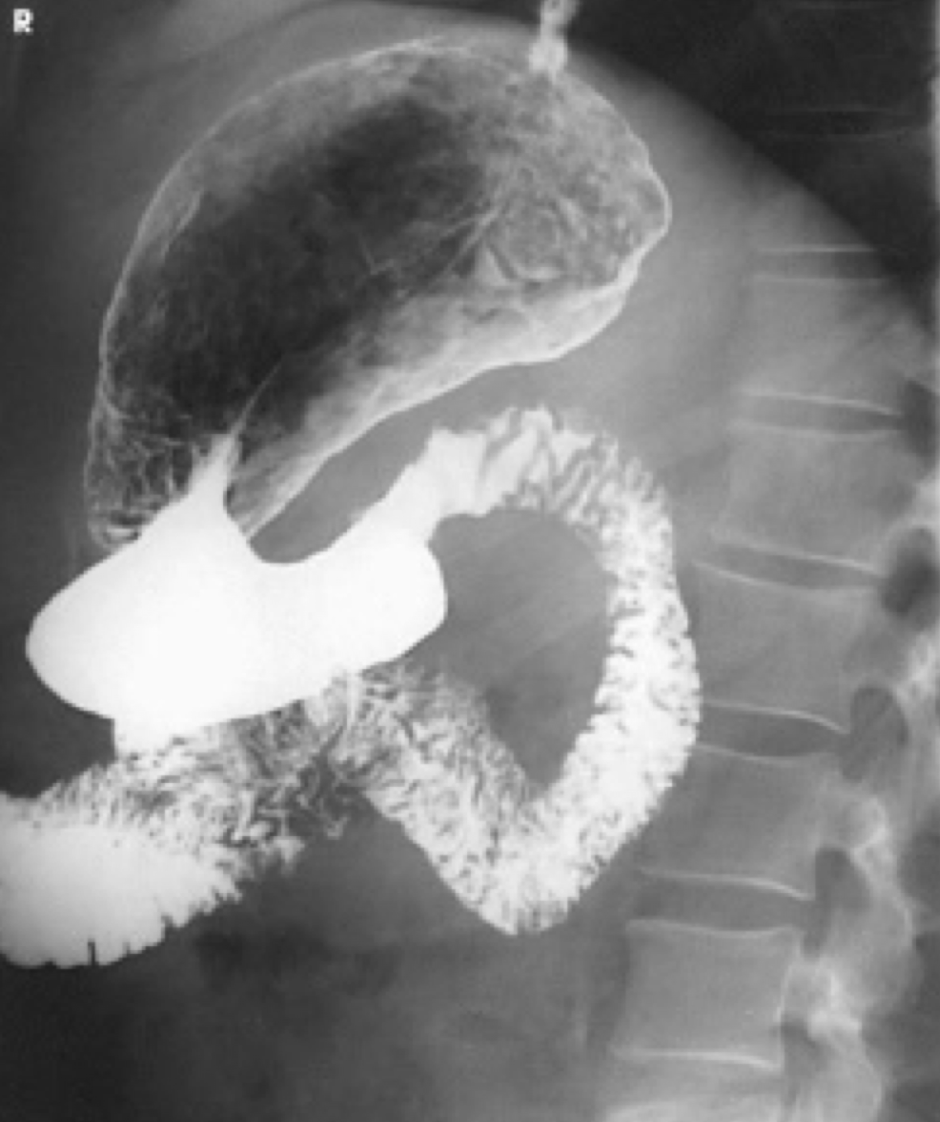 <p>Demonstrates: retrogastric space, pylorus, C-loop of duodenum (in hypersthenic PTs)</p><p>Clinical indications: gastric diverticuli, ulcers and tumors (specifically of retrogastric space)</p>
