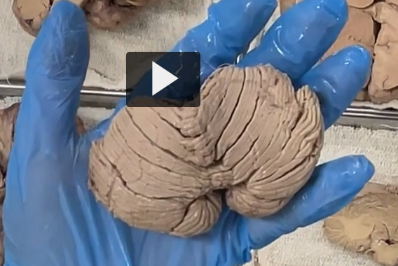 <p>superior surface of the cerebellum </p>