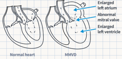 <p>It is a heart condition marked by <strong>thickening and distortion of the mitral valve tissue</strong>, which causes <strong>abnormal blood flow</strong> (regurgitation) and declining heart performance.</p>