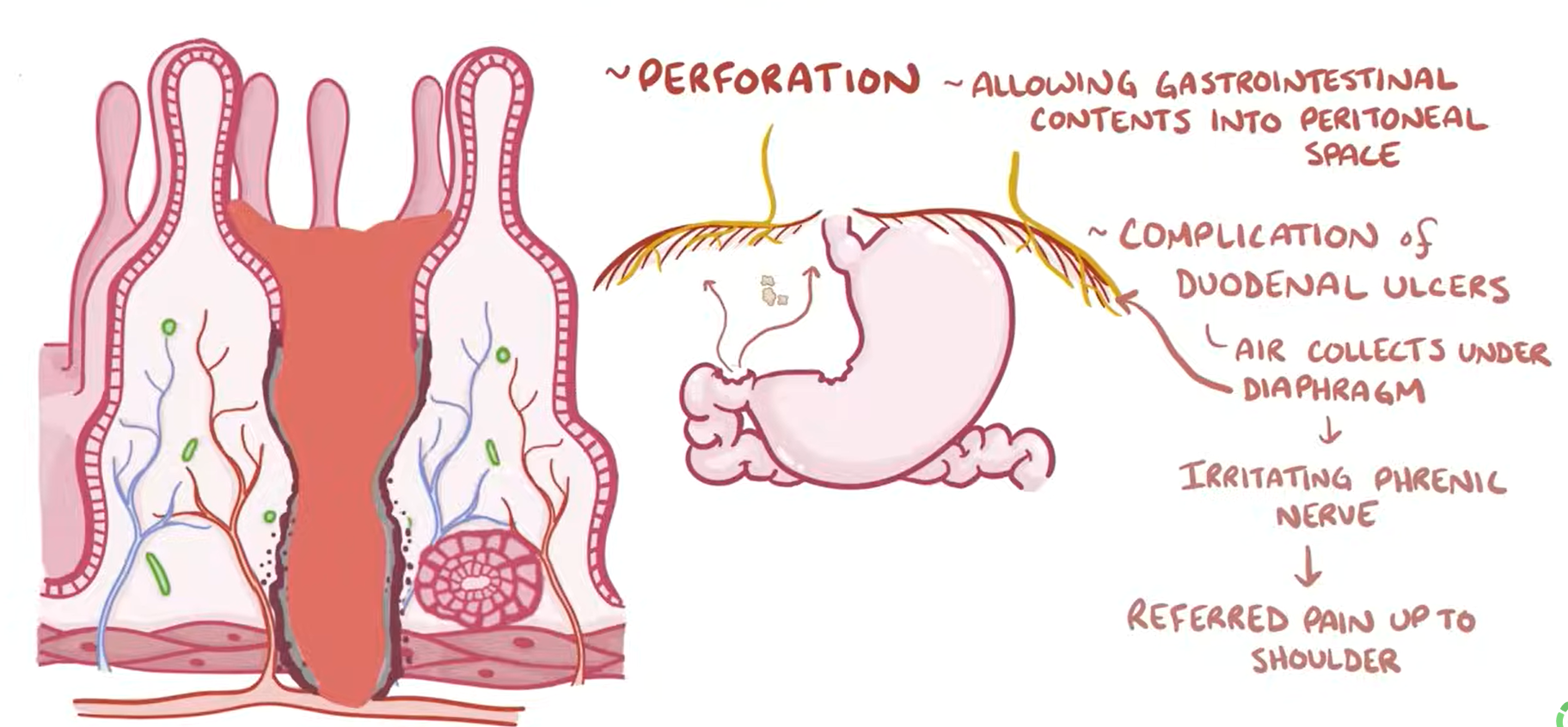 <ul><li><p>Hemorrhage</p><ul><li><p>If on lesser curvature = Bleed from left gastric artery</p></li><li><p>If on posterior wall of duodenum = Bleed from gastroduodenal artery</p></li></ul></li><li><p>Obstruction: Pyloric outlet obstruction, from fibrosis, can also be duodenal obstruction</p></li><li><p><strong><u>Perforation</u></strong>; Anterior duodenal ulcers more common, will see: </p><ul><li><p>Pneumoperitoneum </p></li><li><p>Referred shoulder pain due to phrenic nerve irritation </p></li></ul></li></ul><p></p>
