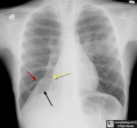 <p>Frontal view: Not well seen as it collapses medially. Right heart border is preserved.<br>Lateral view: Triangular retrocardiac opacity.</p>