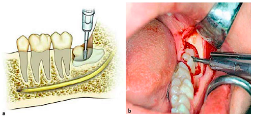 <p>removal of bone between the <span style="color: red;">tooth and cortical plate</span></p><p>to <span style="color: red;">provide purchase point</span> for the instrumentation for the delivery of the tooth</p>
