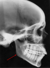 <p>which anatomical landmark:</p><p>- Most convex point along the inferior border of the body of the mandible</p>