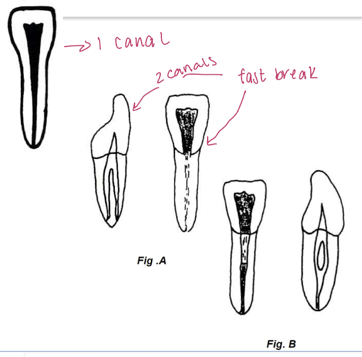 <ul><li><p>can you see one canal clearly on the RG </p></li><li><p>is there an abrupt inc in RO in the canal </p></li><li><p>is there an inc in RO in part of the canal space </p></li></ul><p></p>