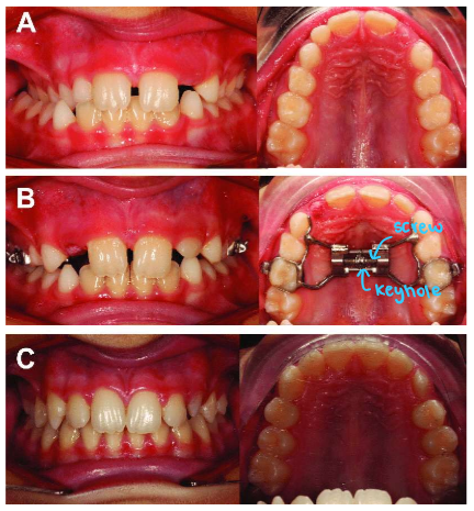 <ul><li><p>image shows posterior crossbite</p></li><li><p>so they used an expander, or rapid max/palatal expansion device (RPED/RMED)</p></li><li><p>you either get skeletal or dental expansion but that depends on the timing its done and what stage the suture is at</p></li></ul><p></p>