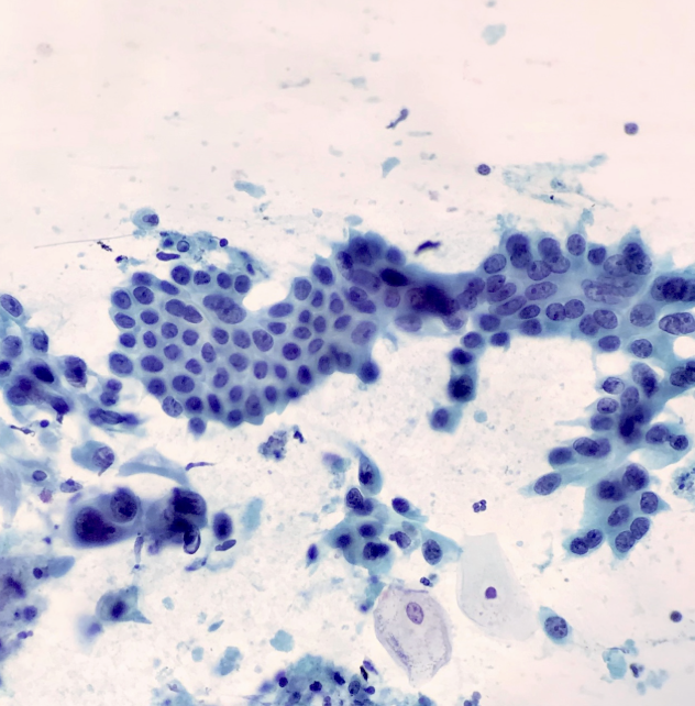 <p>1) terminologie papanicolaou</p><p>2) diagnostic</p><p>3) critères </p><p>4) situations à haut risque de faux+ </p>