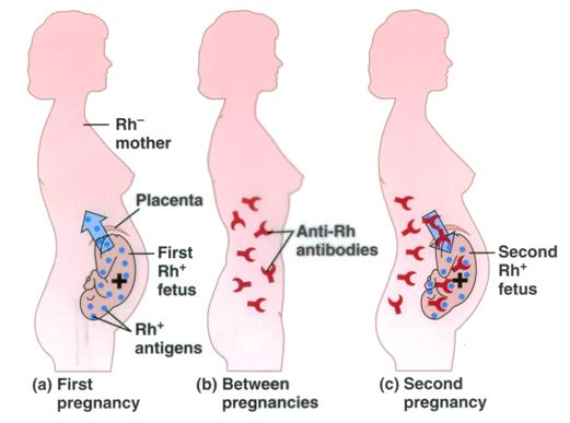 <p><strong><mark data-color="rgba(0, 0, 0, 0)" style="background-color: rgba(0, 0, 0, 0); color: inherit;">a condition where an Rh-negative pregnant person’s immune system produces antibodies against Rh-positive fetal red blood cells</mark></strong><span>. This mismatch, often triggered by a prior miscarriage, trauma, or pregnancy, can cause dangerous hemolytic disease of the fetus/newborn (HDN) in subsequent pregnancies. It is treated with Rho(D) immune globulin injections</span></p>