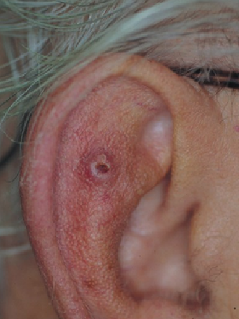 <p>Most common in older patients</p><p>Risk factors: Fair complexion, prolonged sun exposure/UV radiation, long-term immunosuppression</p><p>Usually present as firm, flesh-colored or erythematous papules/plaques</p><p>Primarily managed via surgical excision</p>