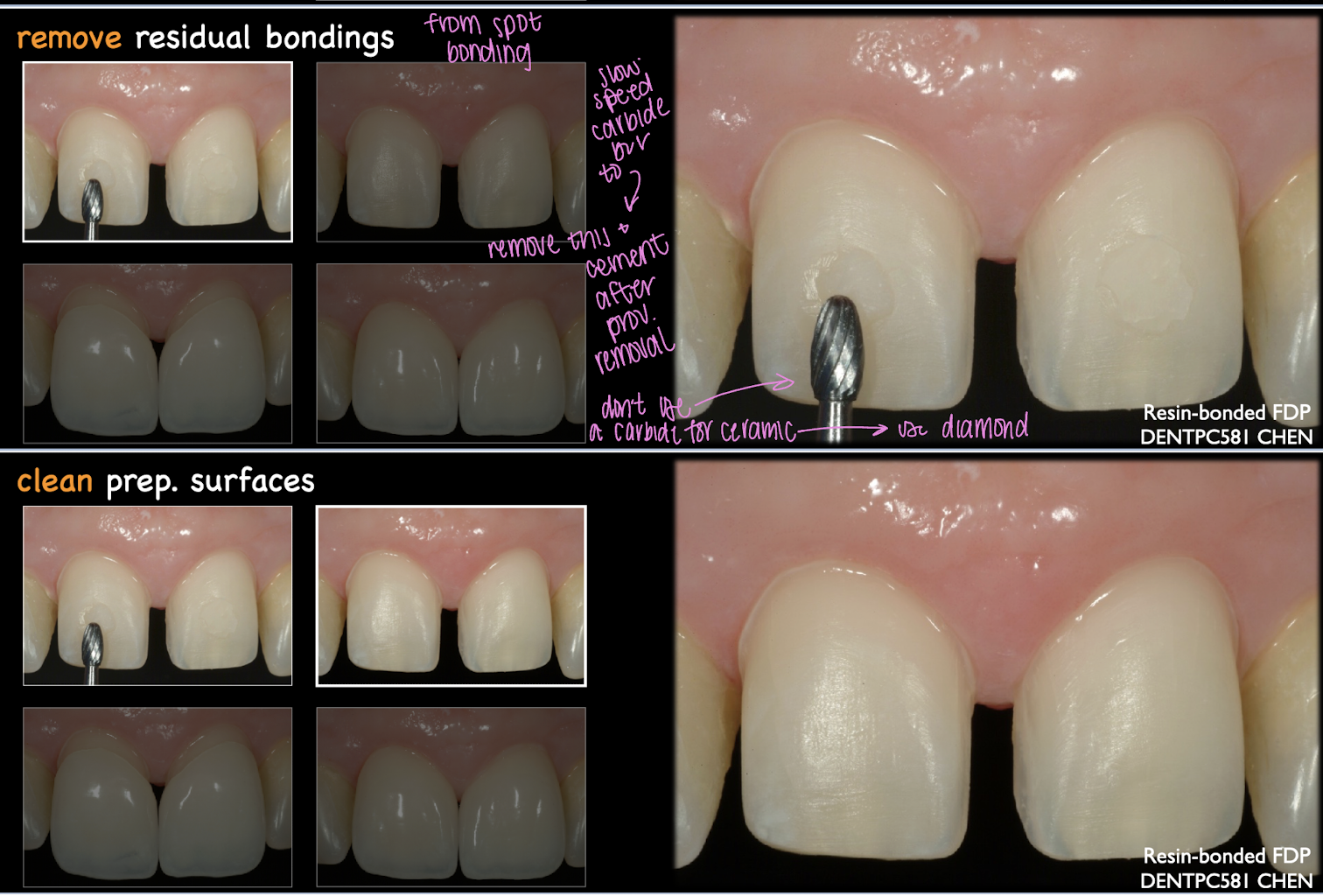 <p>carbide bur w slow speed and clean prepped surfaces </p>