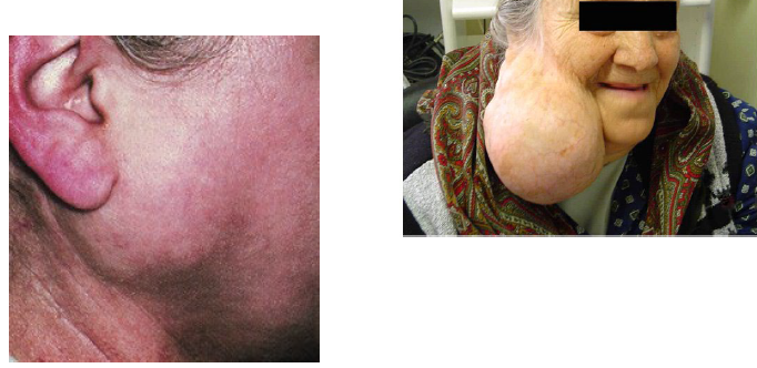 <p>pleomorphic ademona</p>