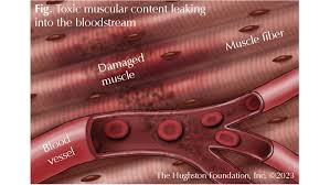 <p>A condition in which <strong>damaged muscle tissue breaks down and releases substances into the blood that can harm the kidneys</strong>.</p>