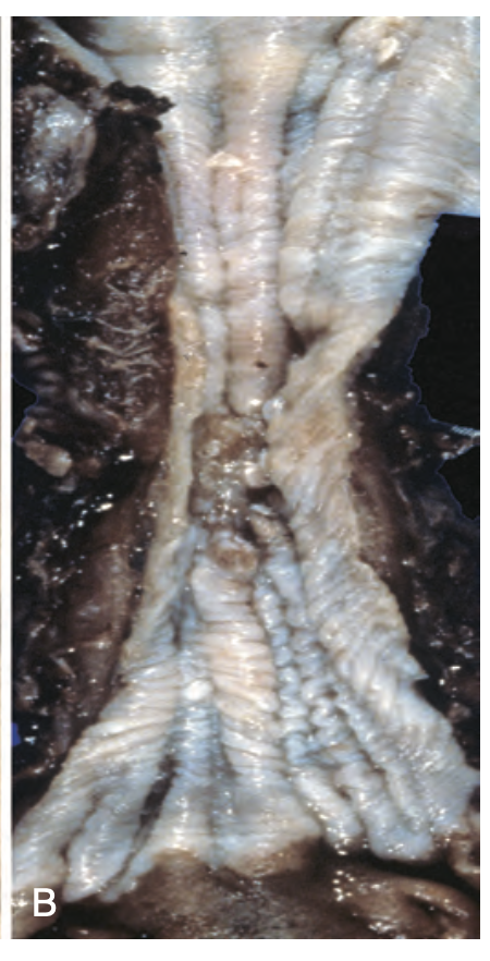 <p>diagnosis, esophageal tumor</p>