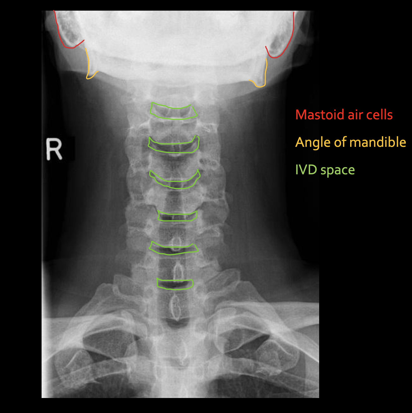 <p><span>Mastoid air cells</span></p>