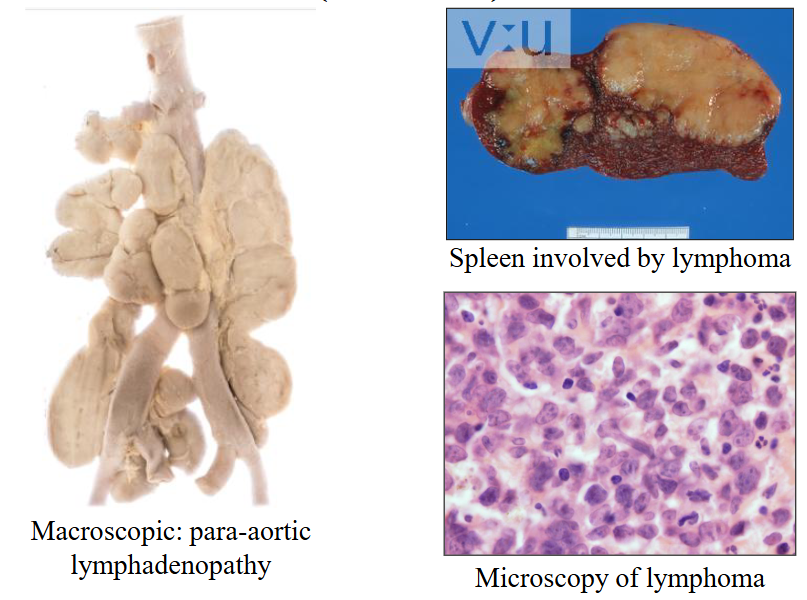 <p>Diffuse Large B-cell lymphoma (DLBCL)</p>