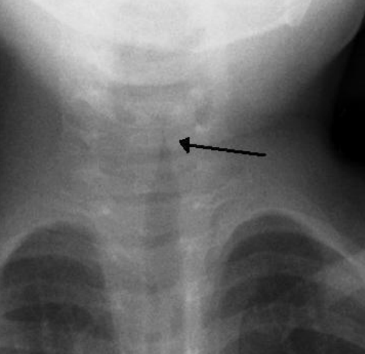 <p>- neck/chest xray for steeple sign (narrowing of the airway)</p><p>- tx is symptomatic and it should be carefully selected to avoid airway obstruction</p><p>- when this is present, we can start seeing the STEEPLE sign in x-rays (narrowing of the airway)</p>