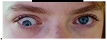 <p>WE ALWAYS specify the eye UP!! </p><p>picture = left <strong>hypertropia</strong></p>