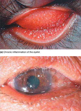 <ul><li><p>Caused by some serotypes of Chlamydia trachomatis</p></li><li><p><strong>Leading cause of blindness worldwide </strong></p></li><li><p>Transmitted via hand contact or flies </p></li><li><p>Infection causes permanent scarring; scars abrade the cornea, leading to blindness </p><ul><li><p>Secondary infections can also be a factor. </p></li></ul></li><li><p>Oral azithromycin is used in treatment.</p></li></ul><p></p>